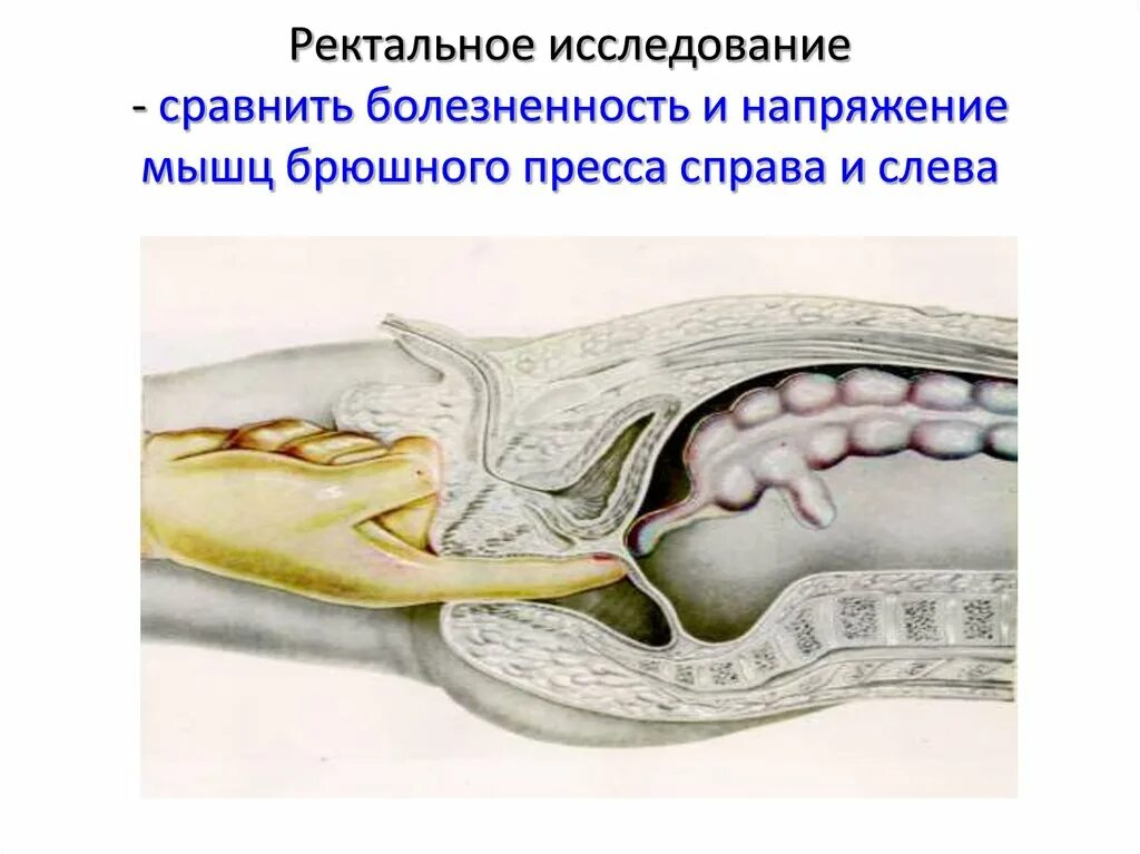 Ректальный заболевании. Пальцевое ректальное исследование. Пальцевое ректальное исследование у детей. Пальцевое ректальное исследование прямой кишки. Ректально-абдоминальное исследование.