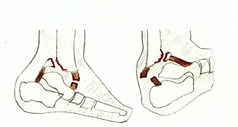 Десто перелом - Перелом внутренней лодыжки и нижней трети малоберцовой кости в с