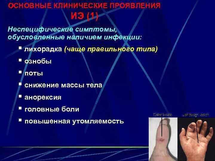 Эндокардит симптомы. Эндокардит симптомы