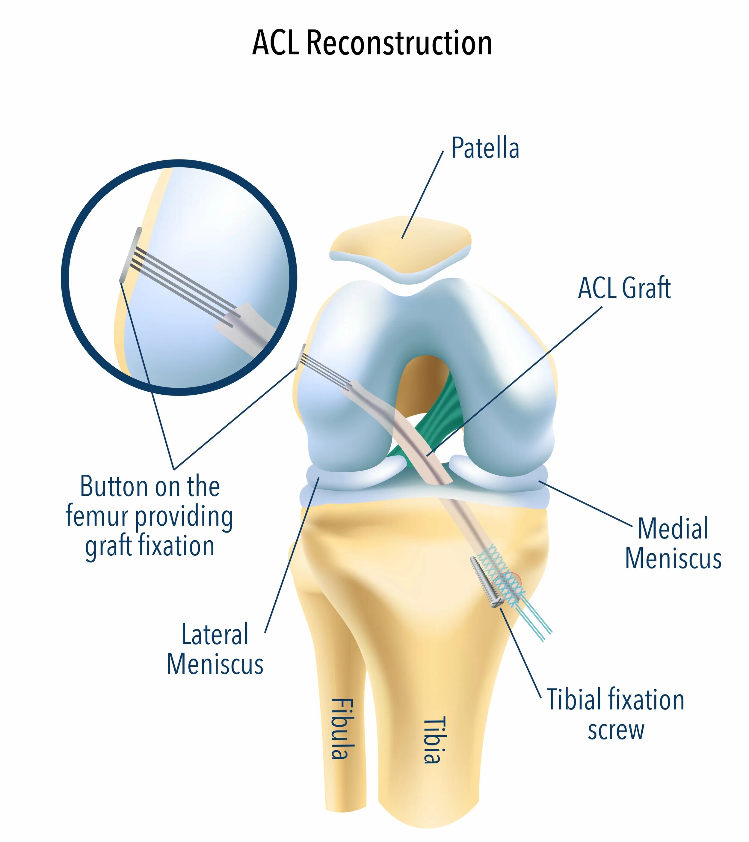 Acl что это. ACL Reconstr.