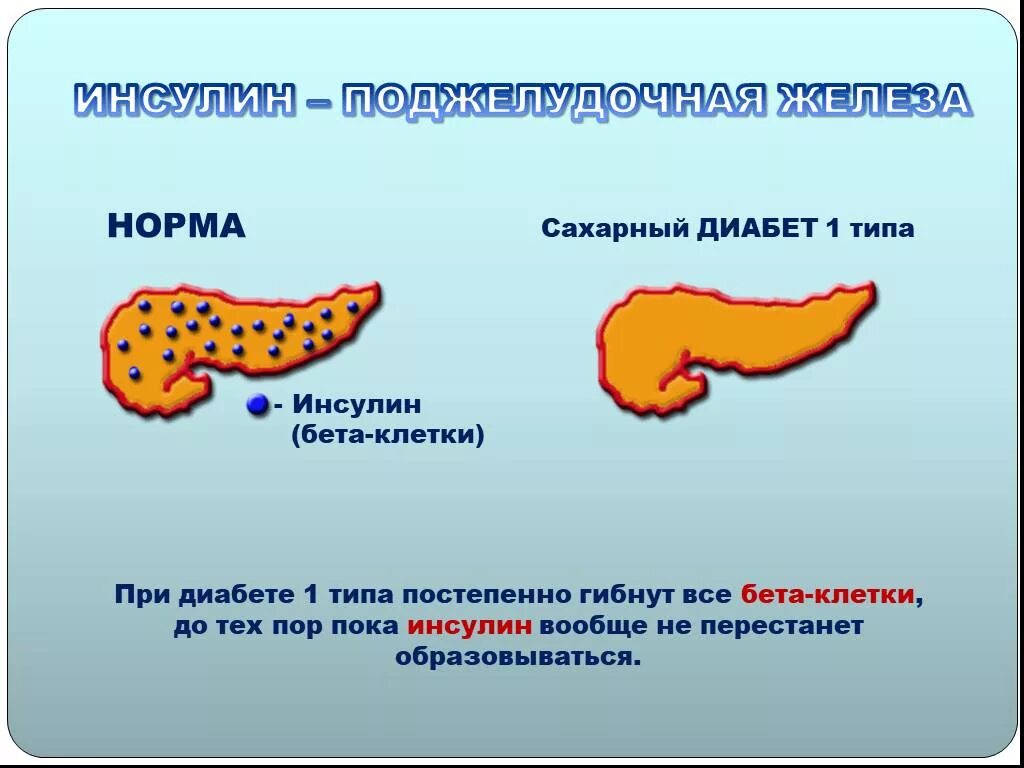 Сахарный диабет 1 типа поджелудочная железа. Поджелудочная железа при сахарном диабете 1 типа. Сахарный диабет 1 типа функции поджелудочной. Изменения поджелудочной железы при сахарном диабете 1 типа. Диабет пересадка поджелудочной железы