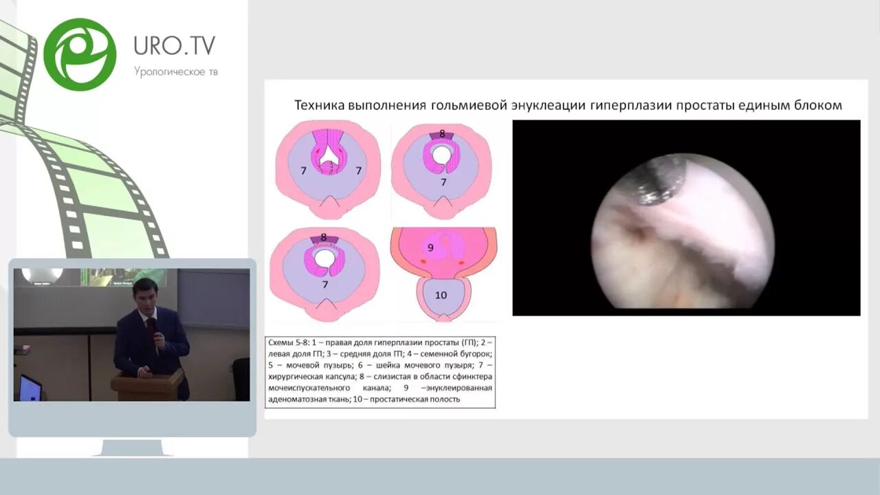 Лазерная энуклеация предстательной. Лазерная энуклеация аденомы. Операция на простату лазерная энуклеация. Трансуретральная лазерная гольмиевая энуклеация простаты-. Лазерная энуклеация аденомы простаты.