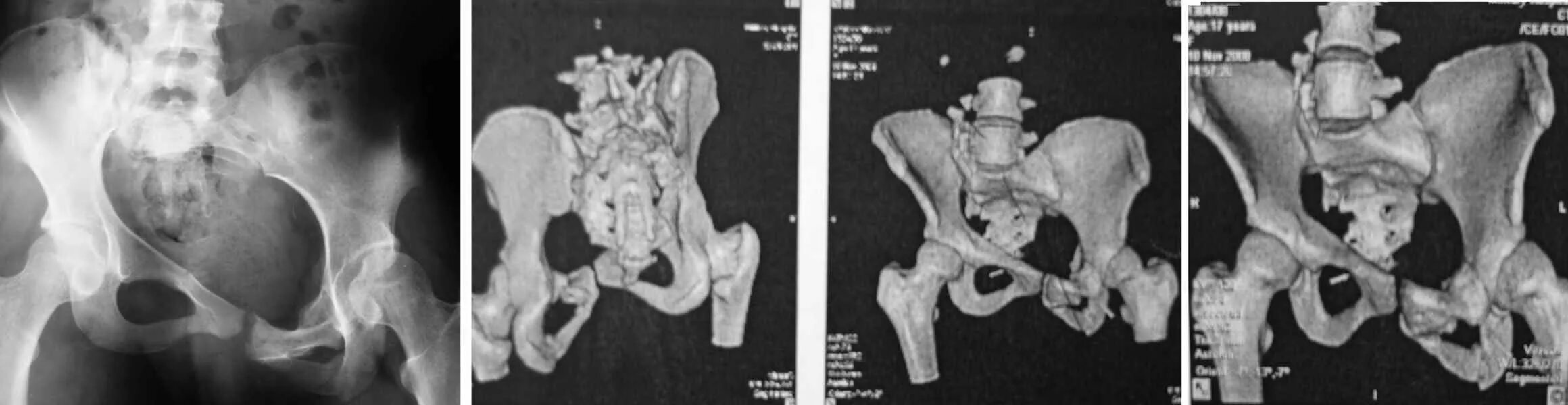 Кт подвздошной кости. Саблевидная лобковая кость рентген. Оскольчатый перелом таза. Кт костей таза перелом лонной кости. Чрезацетабулярный перелом таза.