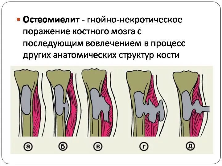Специфические и неспецифические воспалительные заболевания. Воспалительные заболевания кости. Воспалительные заболевания кости. Гнойные заболевания костей и суставов. Синдром воспалительных заболеваний костей и суставов.