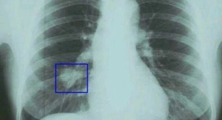 флюорография видит рак. грудные импланты на флюорографии. карцинома легких рентген. снимок легких флюорография. очаговый туберкулез рентген.