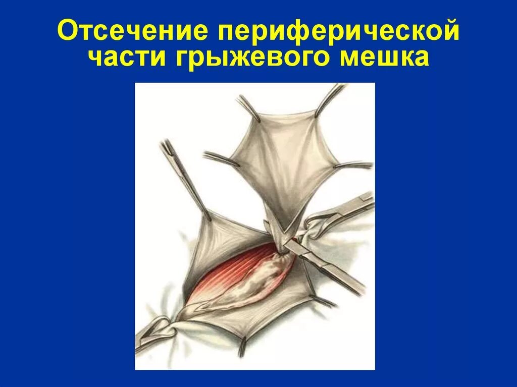 Стенка грыжевого мешка. Составные части грыжевого мешка.