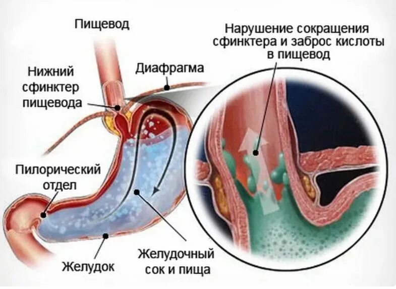 Заброс кислоты в пищевод симптомы