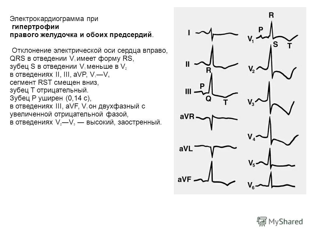смещение электрической оси сердца на экг. отклонение электрической оси сердца на экг. причины отклонения эос вправо на экг. эос вправо на экг у взрослых. отклонение эос на экг.