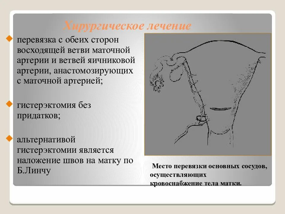 Если месячные если перевязать трубы. Перевязка восходящих ветвей маточных артерий. Перевязка маточных и яичниковых сосудов. Перевязка маточных сосудов с обеих сторон. Билатеральная перевязка маточных сосудов.