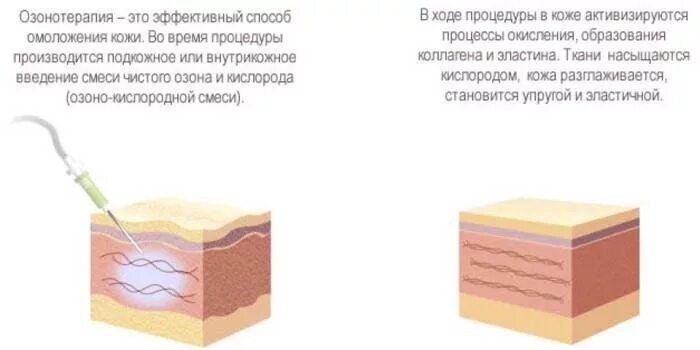 Озонотерапия для чего применяется. Озонотерапия. Озонотерапия методика. Внутривенное Введение озона. Озонотерапия в дерматологии.