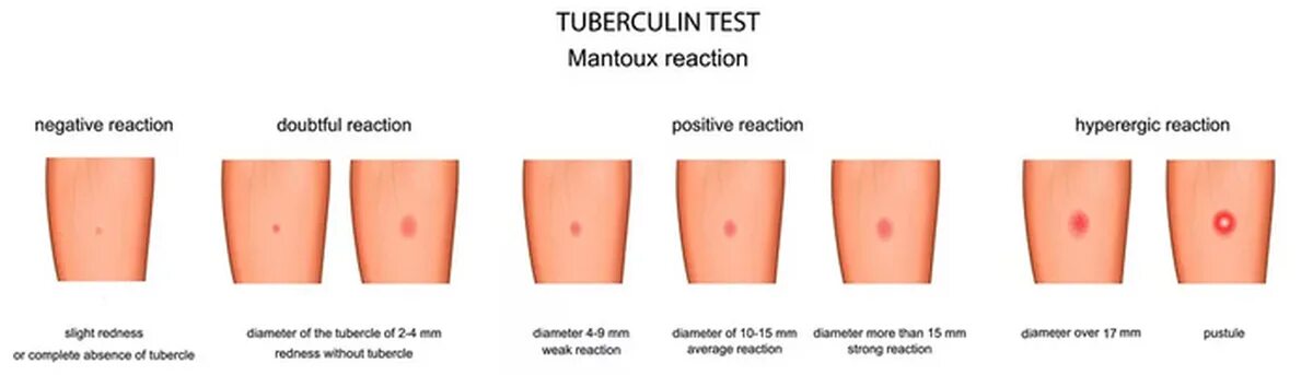Реакция манту у ребенка 7 лет. Норма диаскин диаскинтест. Прививка диаскинтест норма. Папула диаскинтест манту.