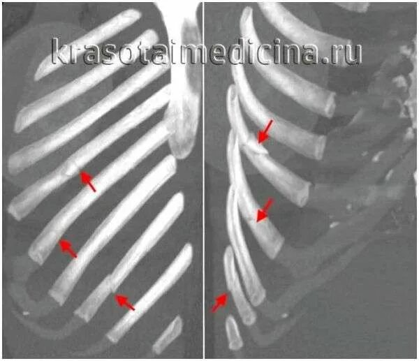 мкб 10 последствия перелома позвоночника. ушиб грудного отдела позвоночника код по мкб 10 у детей. ушиб позвоночника код по мкб 10. ушиб позвоночника мкб 10 код. перелом позвонка код по мкб 10.