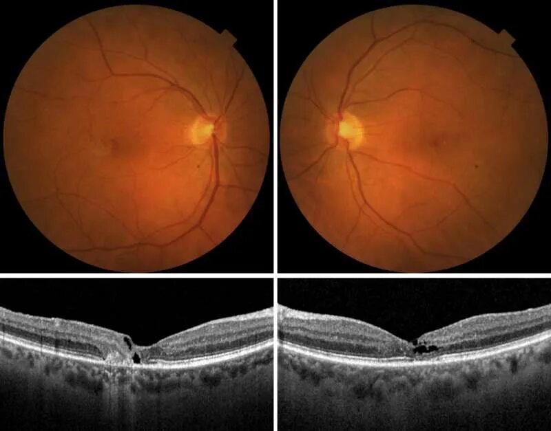 Макулярная дистрофия сетчатки. Макулярный отек сетчатки. Телеангиэктазии сетчатки. Телеангиэктазия макулы. Повреждение сетчатки