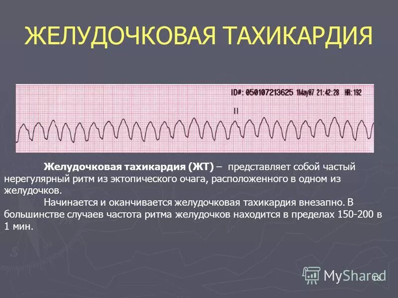 экг при пароксизмальной тахикардии предсердий. внезапное сильное сердцебиение. предсердная пароксизмальная тахикардия клиника. внезапное сильное сердцебиение. внезапное сильное сердцебиение.
