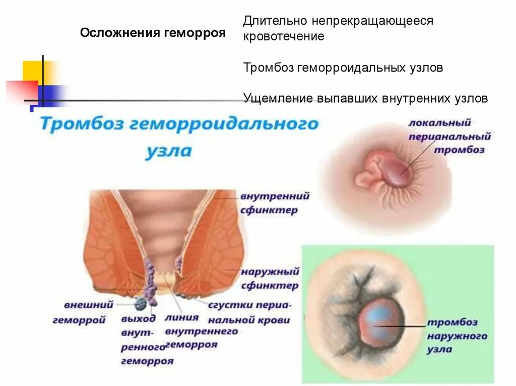 Геморрой причина появления у мужчин лечение. Наружный геморрой тромбоз симптомы. 2 Стадия тромбоза геморроя.