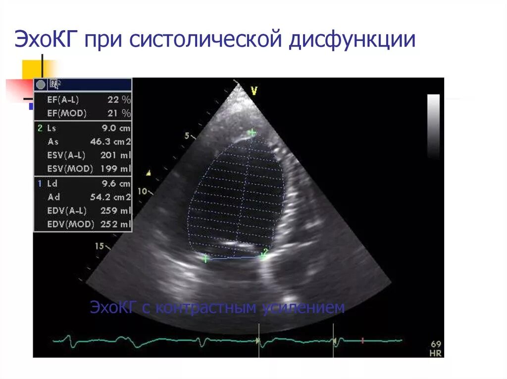 Узи сердца показывает сердечную недостаточность. Хроническая левожелудочковая недостаточность эхокг. эхо кг хсн. эхокардиография сердечная недостаточность. эхокардиография при сердечной недостаточности.