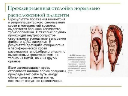 Отслойка плаценты на поздних сроках беременности