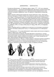 Мкб 10 дюпюитрена