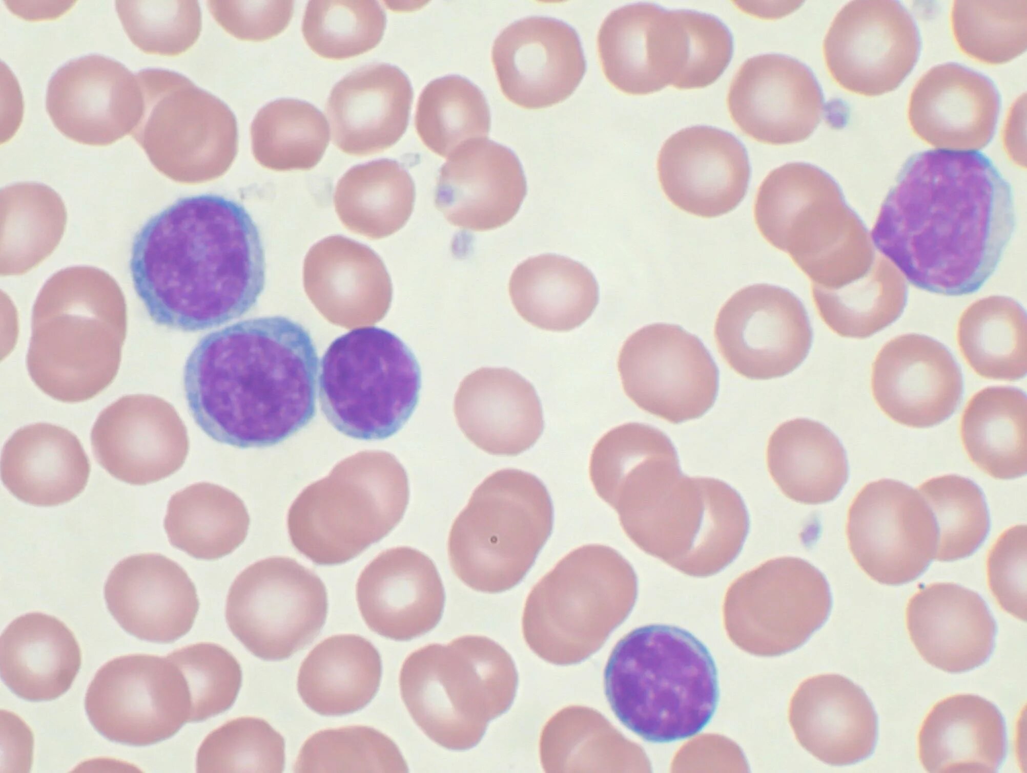 Культивирование лимфоцитов периферической крови. Хронический лимфолейкоз лейкоз клетки. Хронический лимфолейкоз мазок. Хронический лимфолейкоз мазок крови. Клетки Боткина Гумпрехта это.