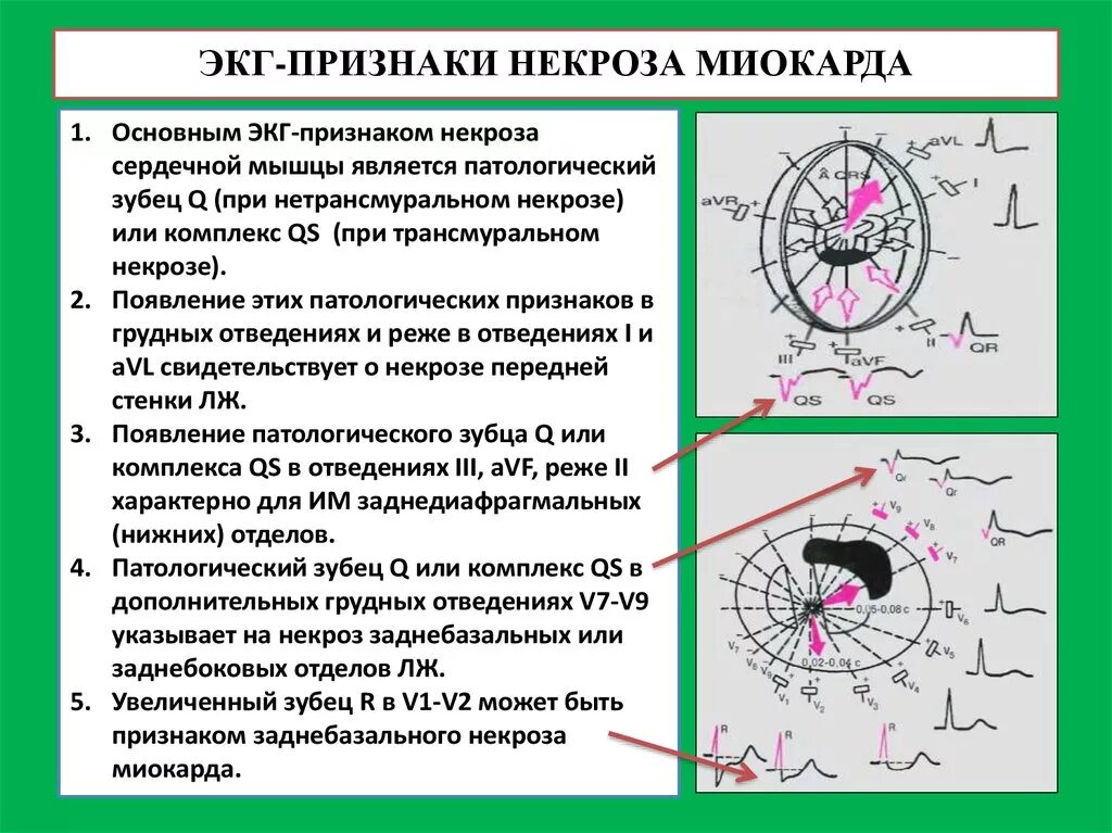 Признаком ишемии является. Некроз сердечной мышцы на ЭКГ признаки. Основными ЭКГ признаками некроза сердечной мышцы является:. Признак некроза миокарда на ЭКГ. Некроз сердечной мышцы на ЭКГ.