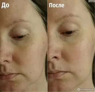 Гепариновая для лица отзывы