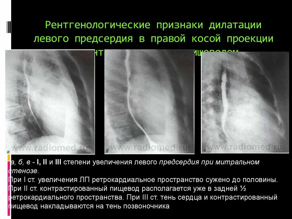 Дилатация правых отделов. Пищевод на рентгене в боковой проекции. Митральный стеноз рентгенография. Правая косая проекция пищевода. Рентген сердца в правой косой проекции.