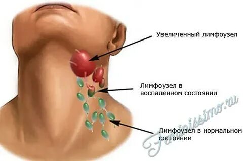 Удаление лимфатического узла операция