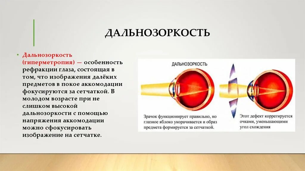 При дальнозоркости изображение предмета фокусируется