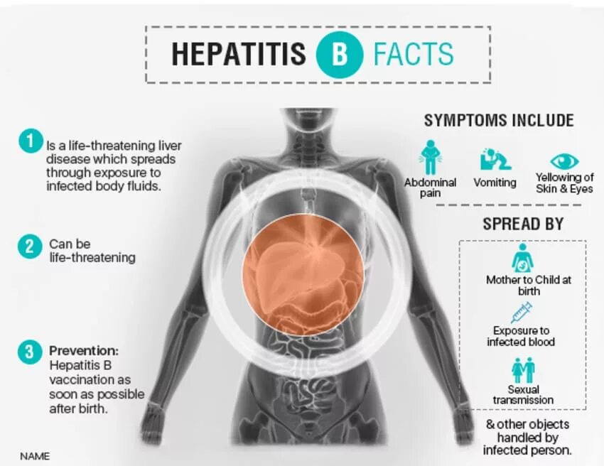 Be life threatening. Гепатит е. Гепатит е строение. Вирус гепатита е строение.