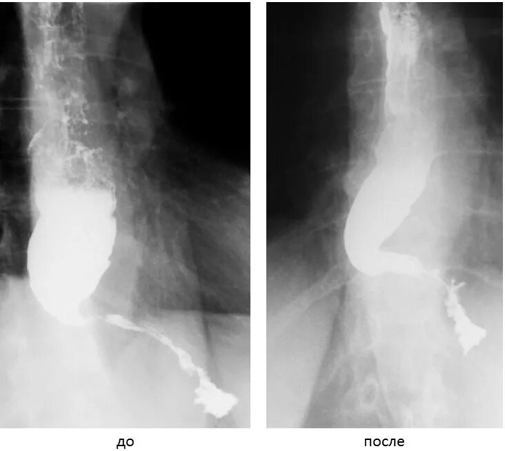 Халазия и ахалазия пищевода. Ахалазия пищевода рентген. Ахалазия кардии пищевода рентген. Кардиоспазм пищевода рентген. Халазия пищевода