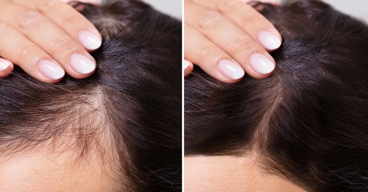 Втирать в корни волос. Мезотерапия волос до и после. Выпадение волос до и после. Мезотерапия волос головы. Залысины на голове у женщин.