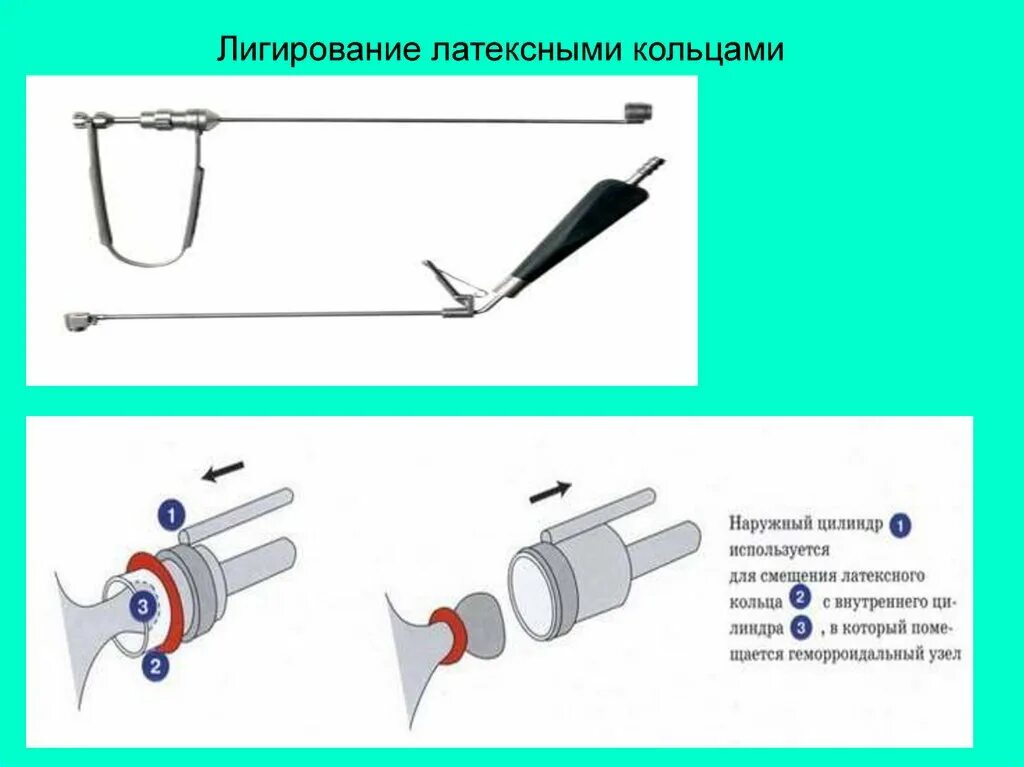 После лигирование геморроидальных узлов. Латексные кольца для лигирования геморроидальных. Лигирование латексными кольцами. Легендирование латексными кольцами. Лигирование внутренних геморроидальных узлов.