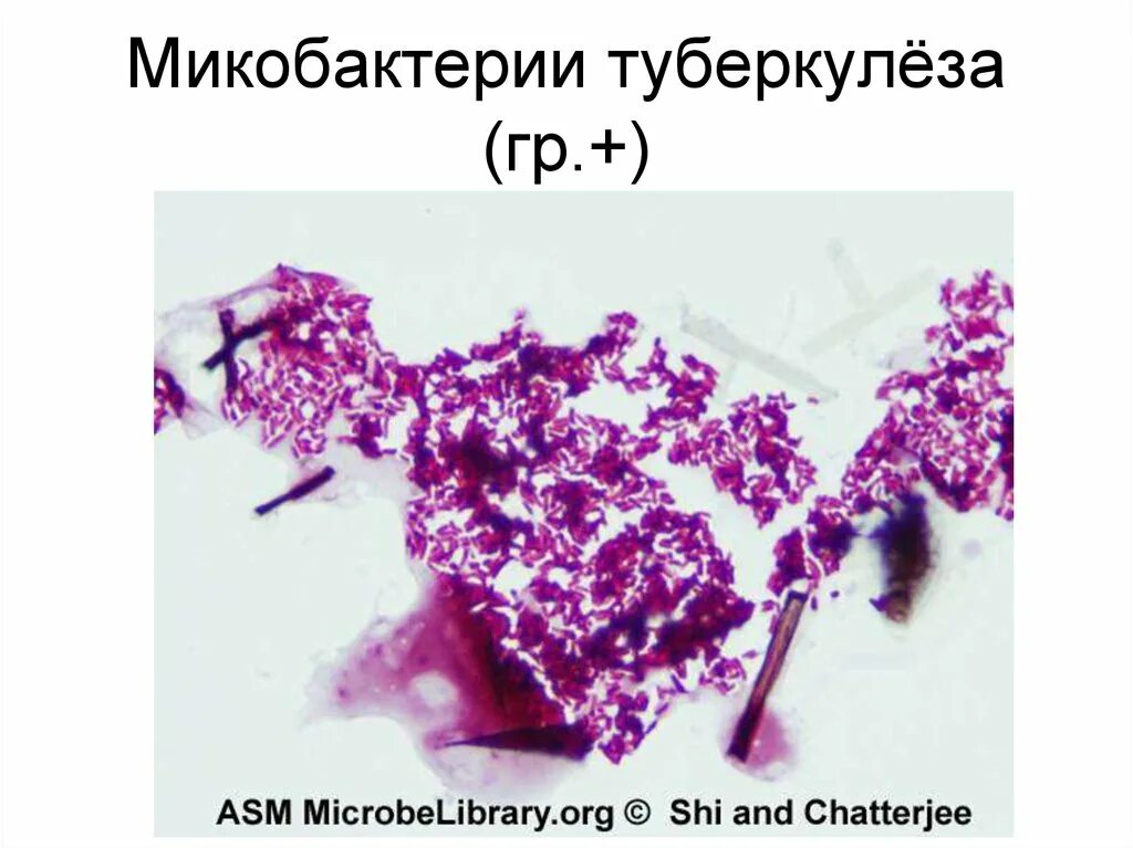 Род туберкулеза. Микобактерии туберкулеза окраска по Граму. Микобактерии туберкулеза микроскопия. Туберкулез микробиология. Морфология микобактерий туберкулеза.