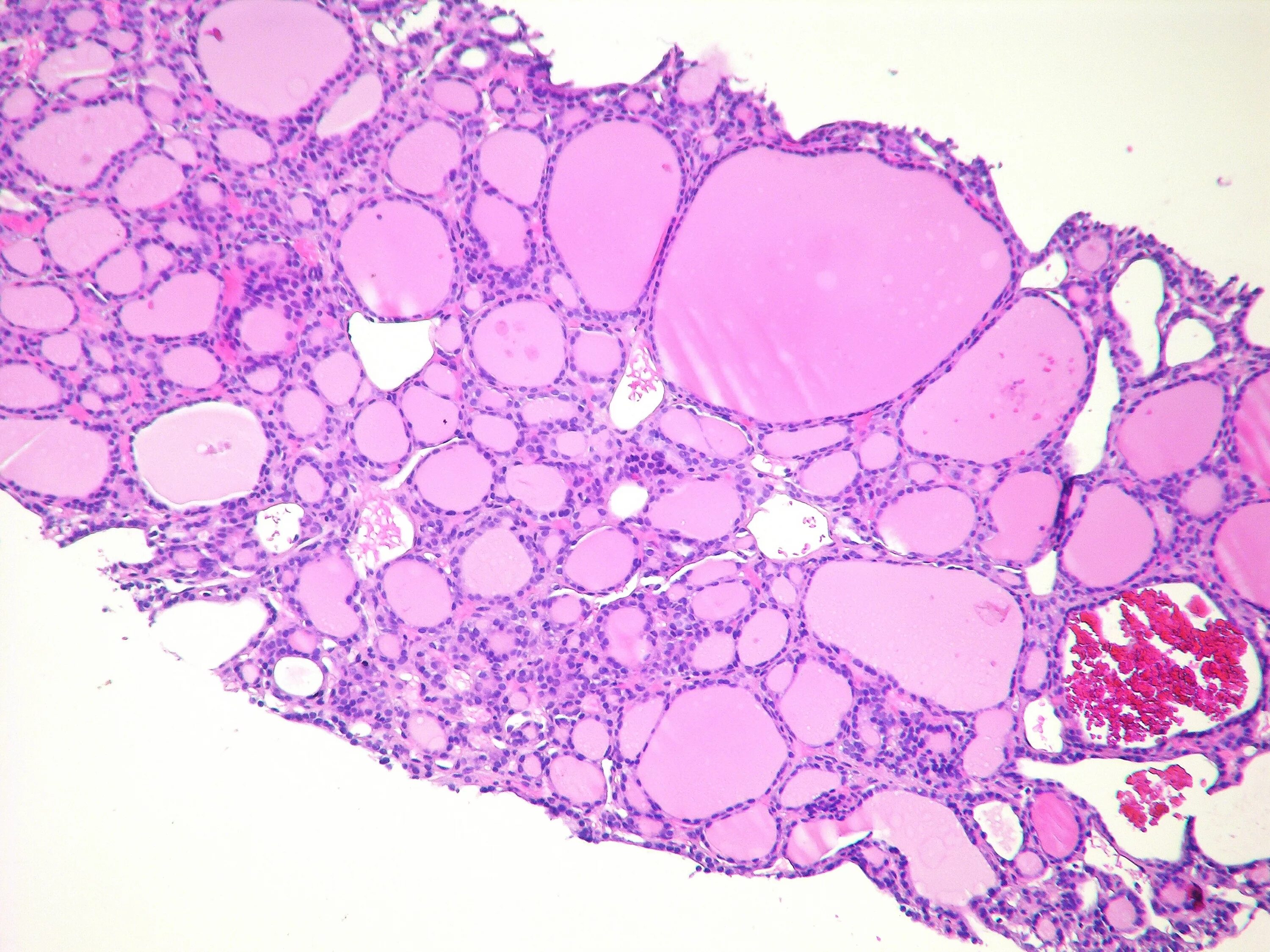 Коллоидный зоб гистология. Зоб Хашимото гистология. Патология щитовидной железы гистология. Токсический зоб гистология.
