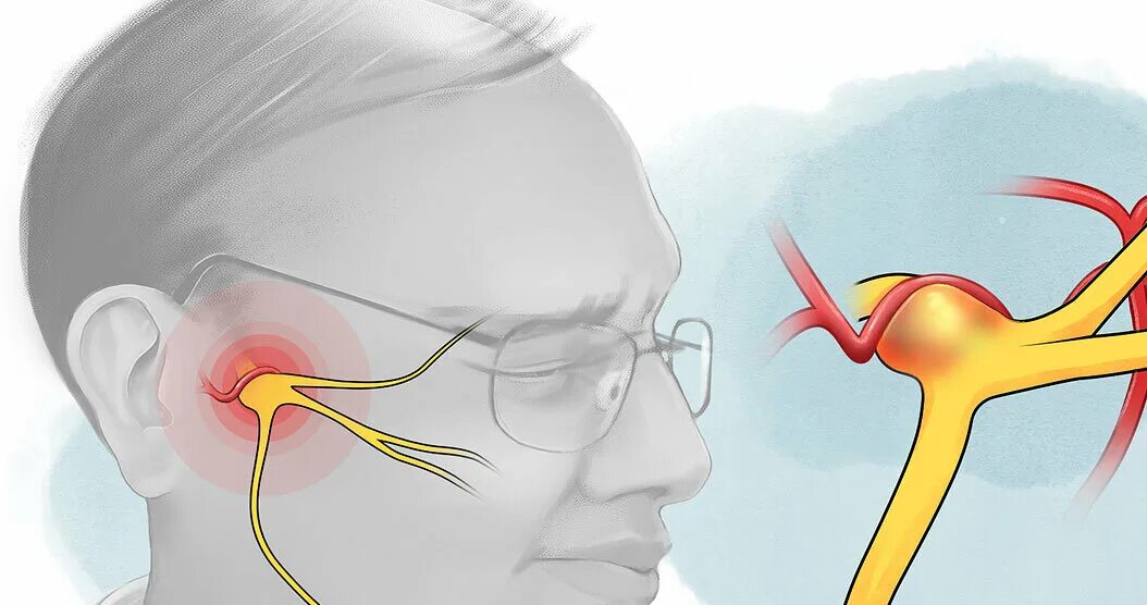 Как понять что воспалился нерв. Воспаление тройничного лицевого нерва. Лицевой нерв схема. Неврит тройничного нерва клиника. Тройничный нерв анатомия воспаление.