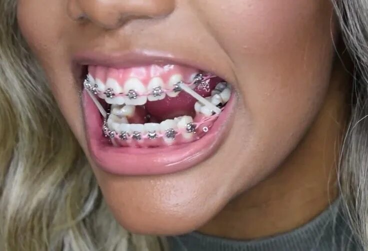 Брекеты посмотреть как будут выглядеть #beugels #Braces #comfortable #Invisible #Mode #Modern #beugels #Braces #comfort