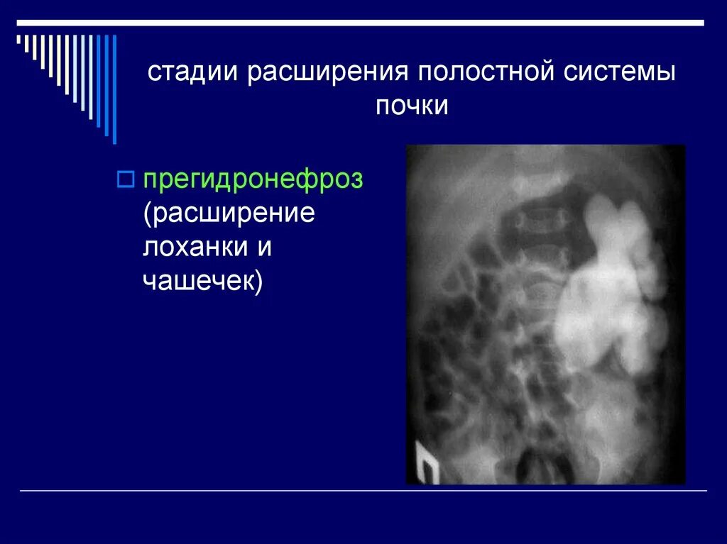 Стадии расширения полостной системы почки. Полостная система почки расширена что это. Расширение ЧЛС почек. Степени расширения ЧЛС.