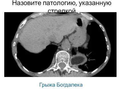 Грыжа бохдалека