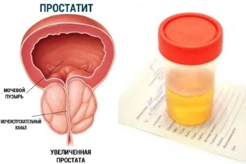 Моча простата. Моча при простатите. кровь в моче при мочеиспускании. моча при простатите у мужчин.