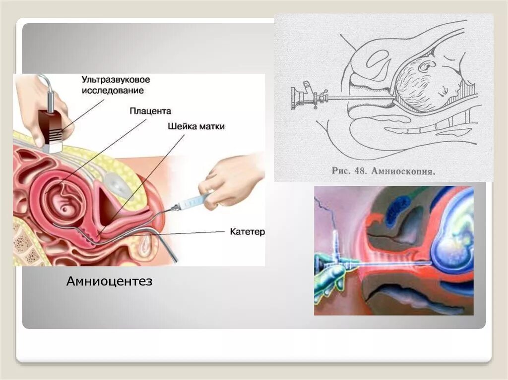 Амниоскопия и амниоцентез. Амниоскопия околоплодных вод. Амниоскопия при беременности. Почему у беременной зеленые воды