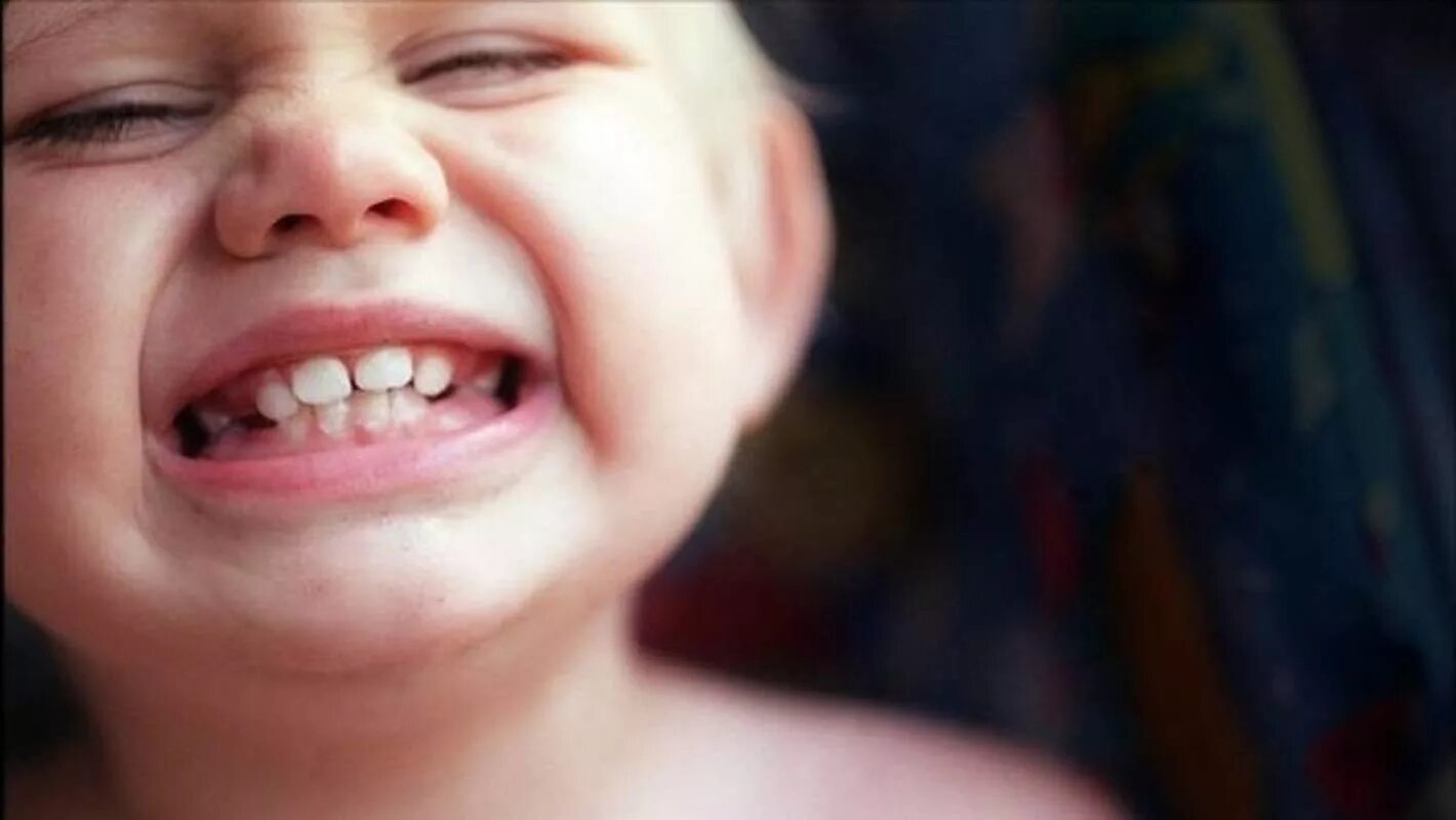 Зубы у годовалого. Кариес передних зубов у детей. Кариес молочных зубов серебрение. Зубы у годовалого. Гипоплазия молочных зубов.