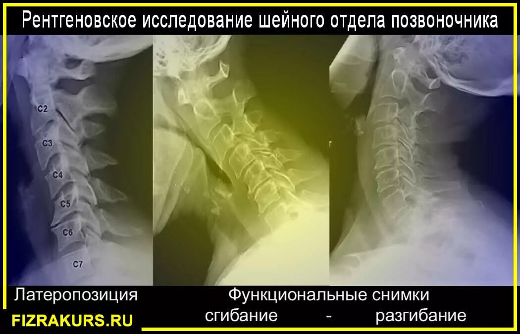 Рентген шоп с функциональными пробами. Снимки шейного отдела с функциональными пробами. Кт пояснично-крестцового отдела. Рентген шеи сбоку норма. Рентген шейного отдела позвоночника с функциональными пробами.