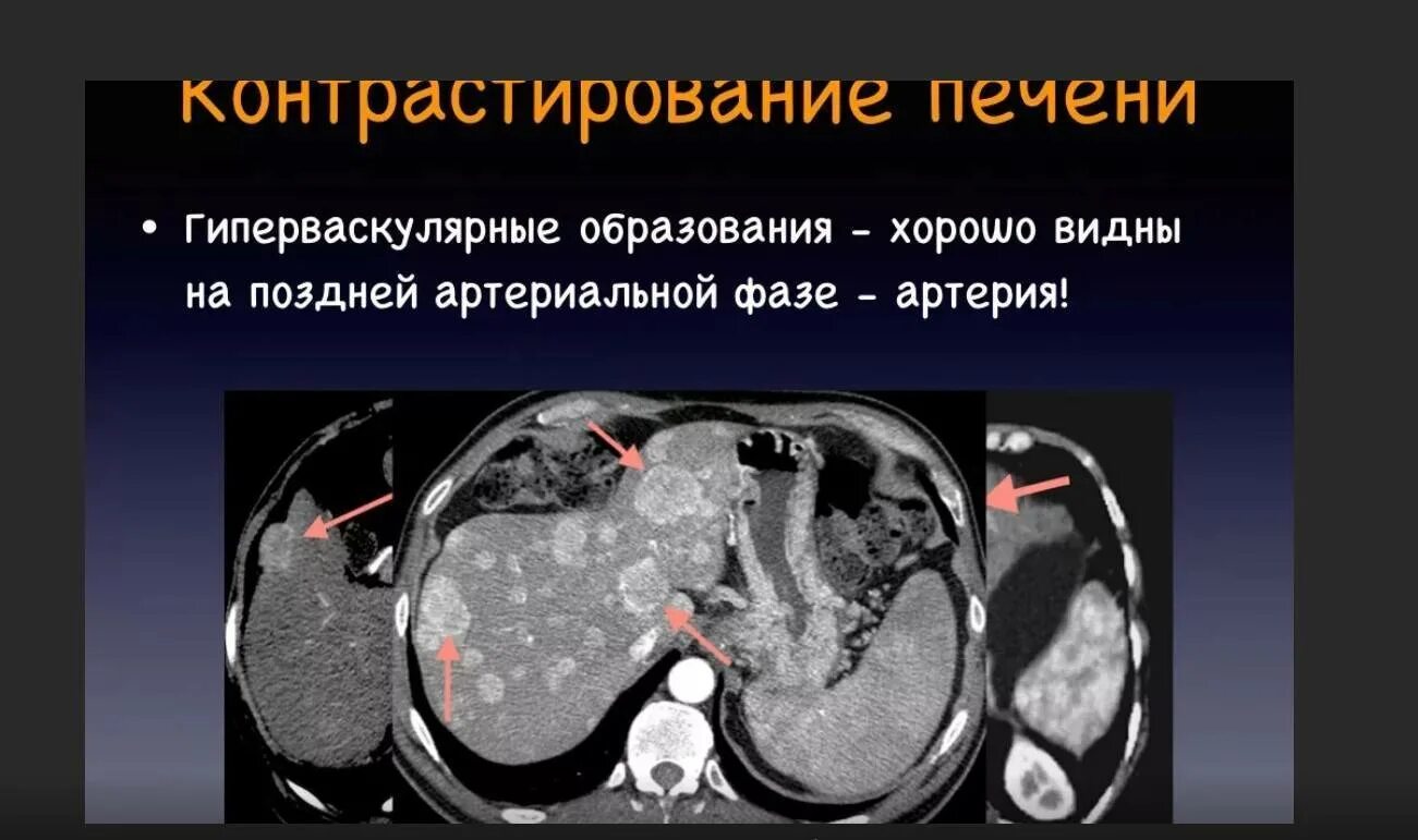 Округлые образования печени. Гиперваскулярные образования печени. Артериовенозные шунты кт. Гиподенсный очаг печени кт. Гиперваскулярные очаги в печени кт.