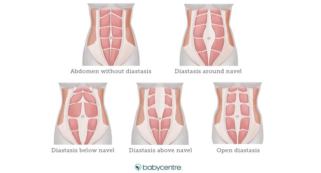 Диастаз брюшной стенки. Мышцы живота анатомия диастаз. Диастаз прямой мышцы беременность.
