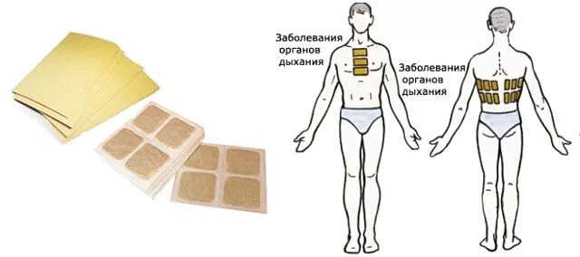 Можно ли при бронхите ставить горчичники взрослым. Куда ставить горчичники при кашле. Схема постановки горчичников при бронхите. Схема постановки горчичников при кашле у ребенка. Перцовый горчичники при кашле.