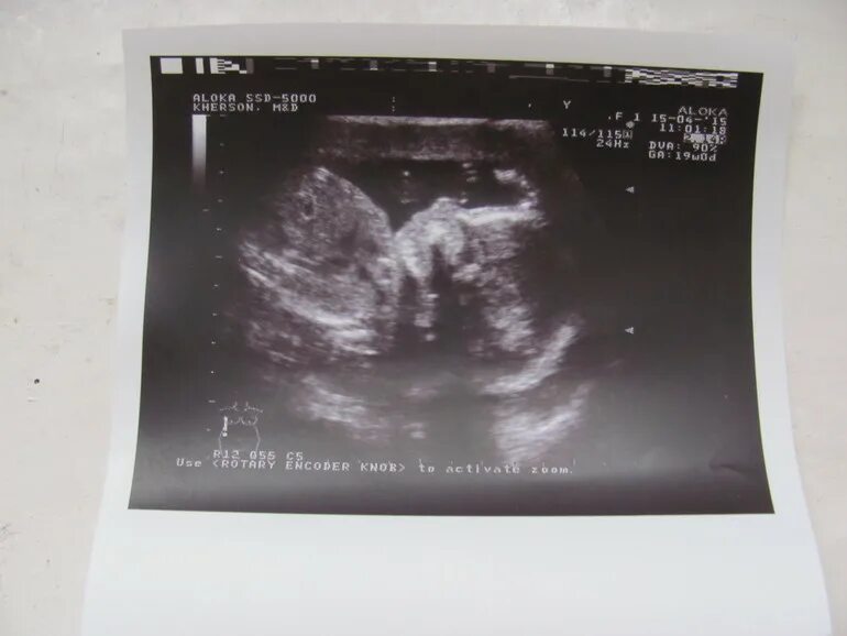 скрининг 10 недель фото. 2 скрининг 21 неделя узи. узи 20 неделя недель беременности. узи беременности 2 скрининг 20 недель. 23 недели беременности узи протокол.