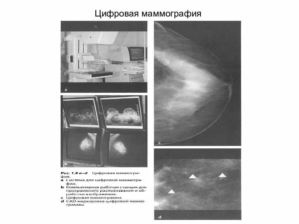 Анализ маммографии. Образование молочной железы на маммографии. Цифровая маммография. Цифровая маммография молочных желез.