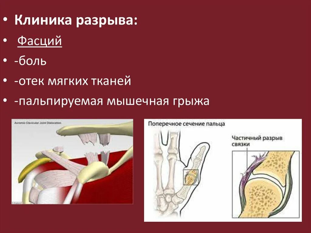 Отдел разрыв. Клиника повреждения связок. Повреждения мышц, клиника.. Разрыв мягких тканей клиника.