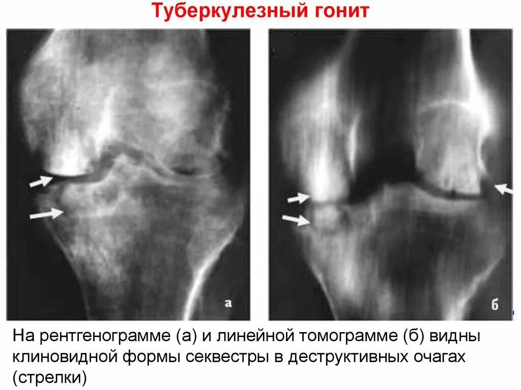 Костный туберкулез коленного сустава. Туберкулез коленного сустава 2 стадия рентген. Остеомиелит коленного сустава рентген. Туберкулезный остеомиелит рентген.