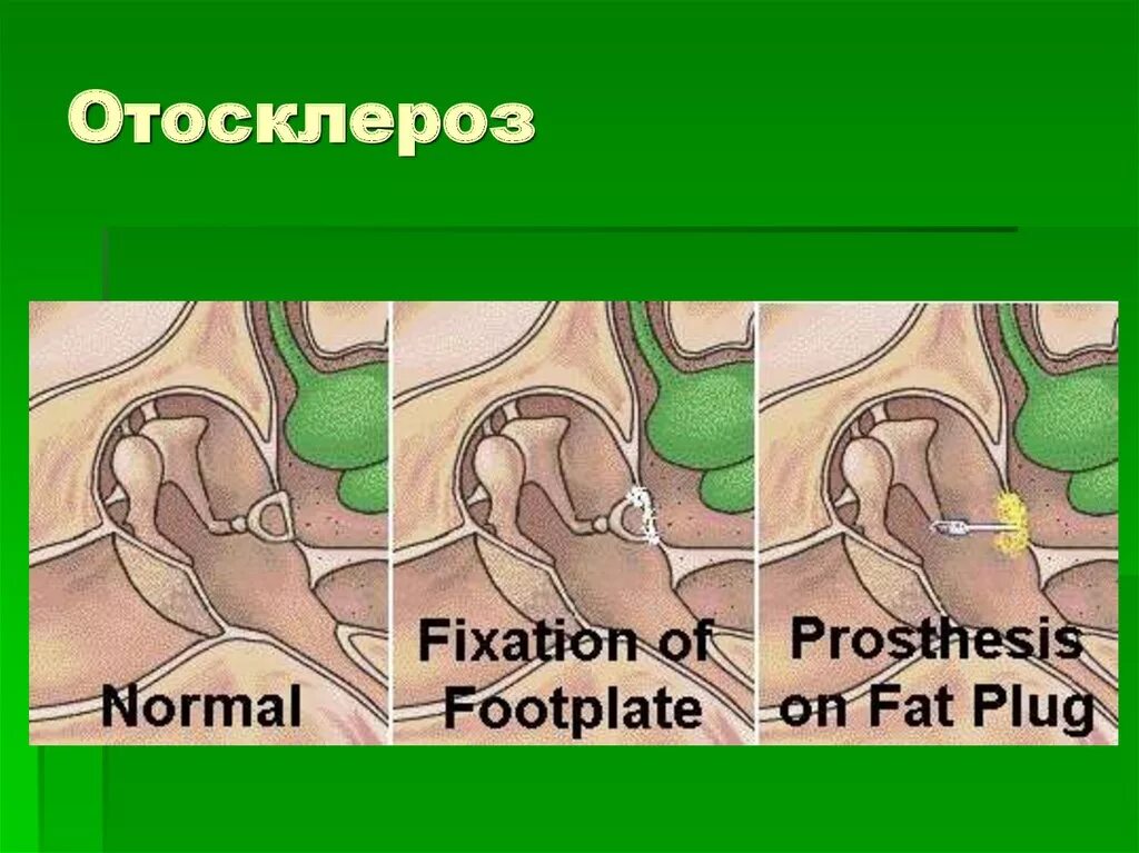 Отосклероз уха операция. Кондуктивный отосклероз. Болезни среднего уха отосклероз. Отосклероз овального окна.